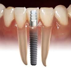 dental implant single implant