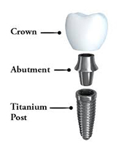 dental-implant-structure
