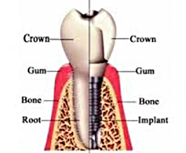dental implant in gum