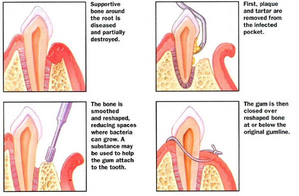 periodontal-process-osseous-surgery